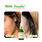 Clear: Acne clearing serum