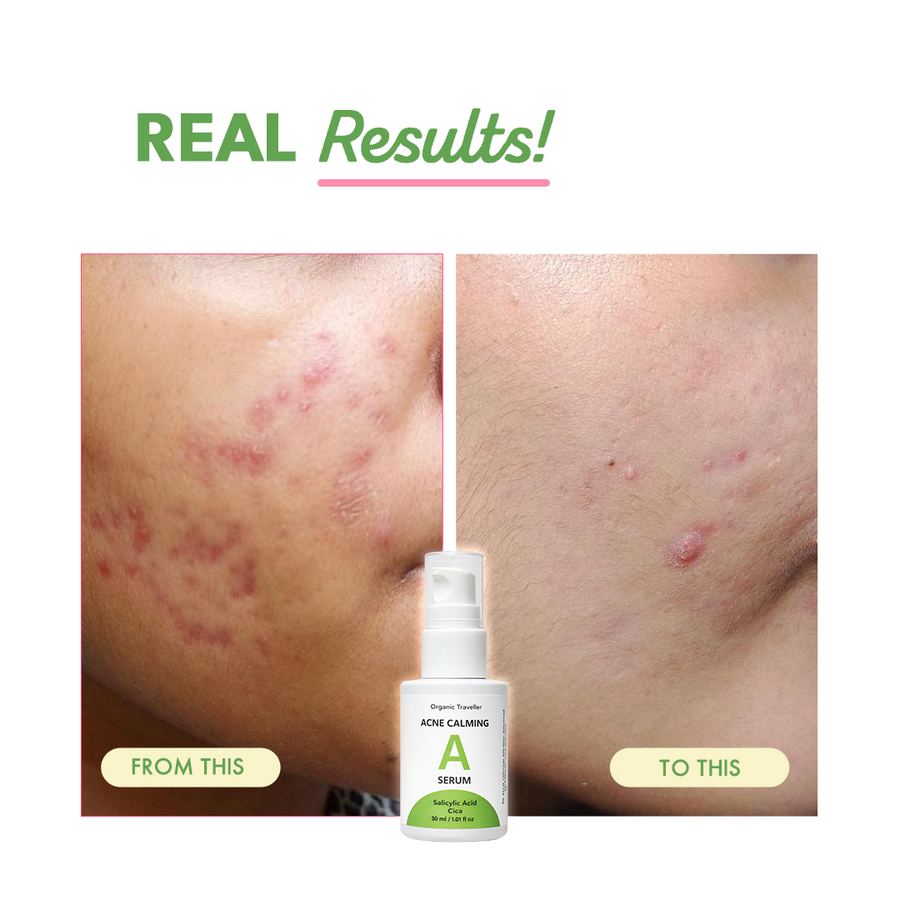 Acne Calming Serum